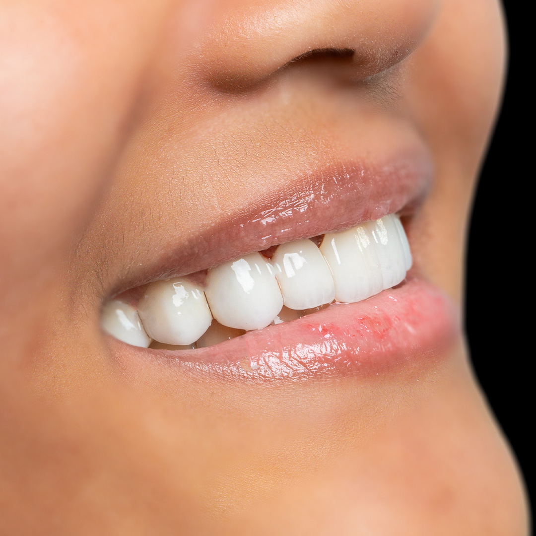 Veneers case 1 after treatment