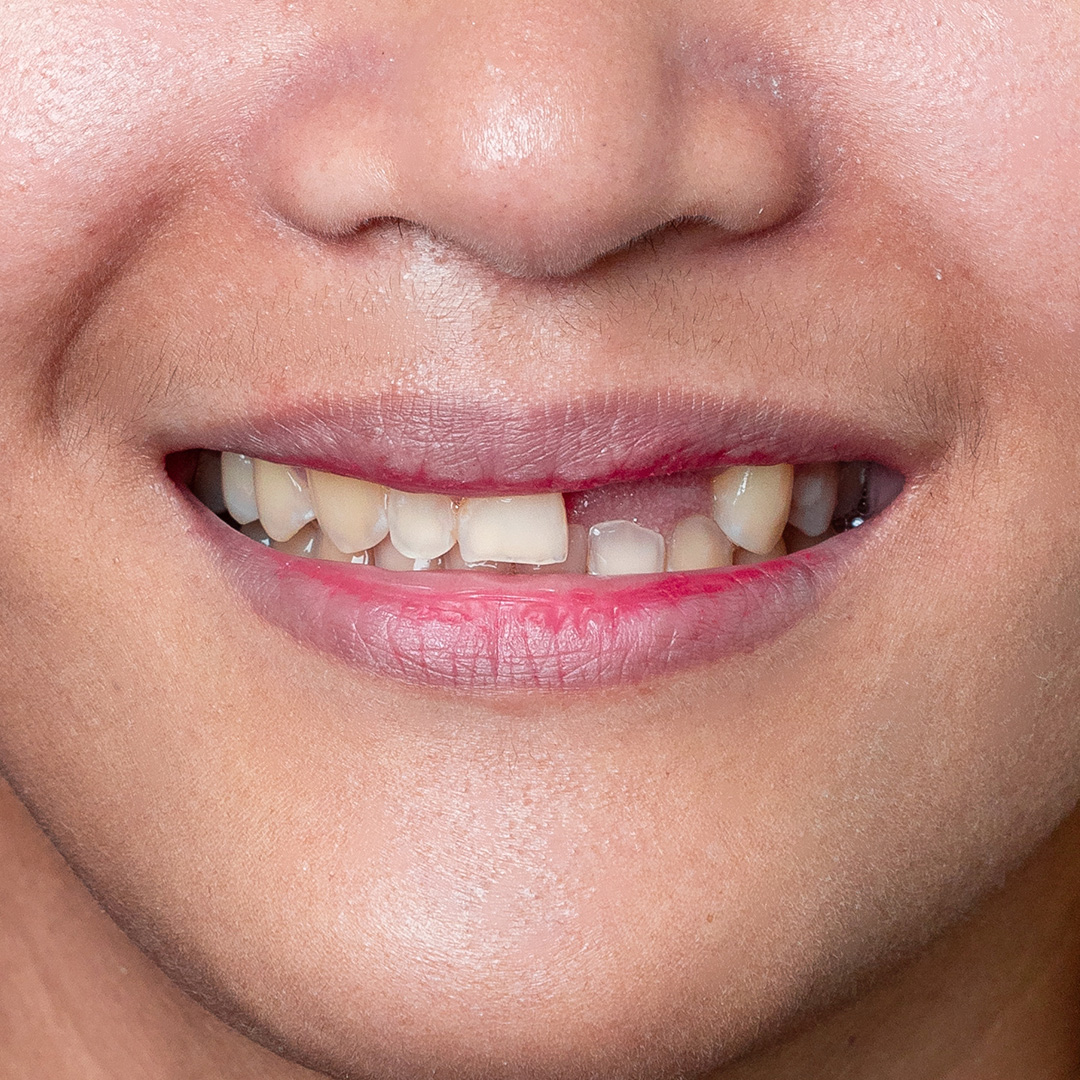 Veneers case 1 before treatment