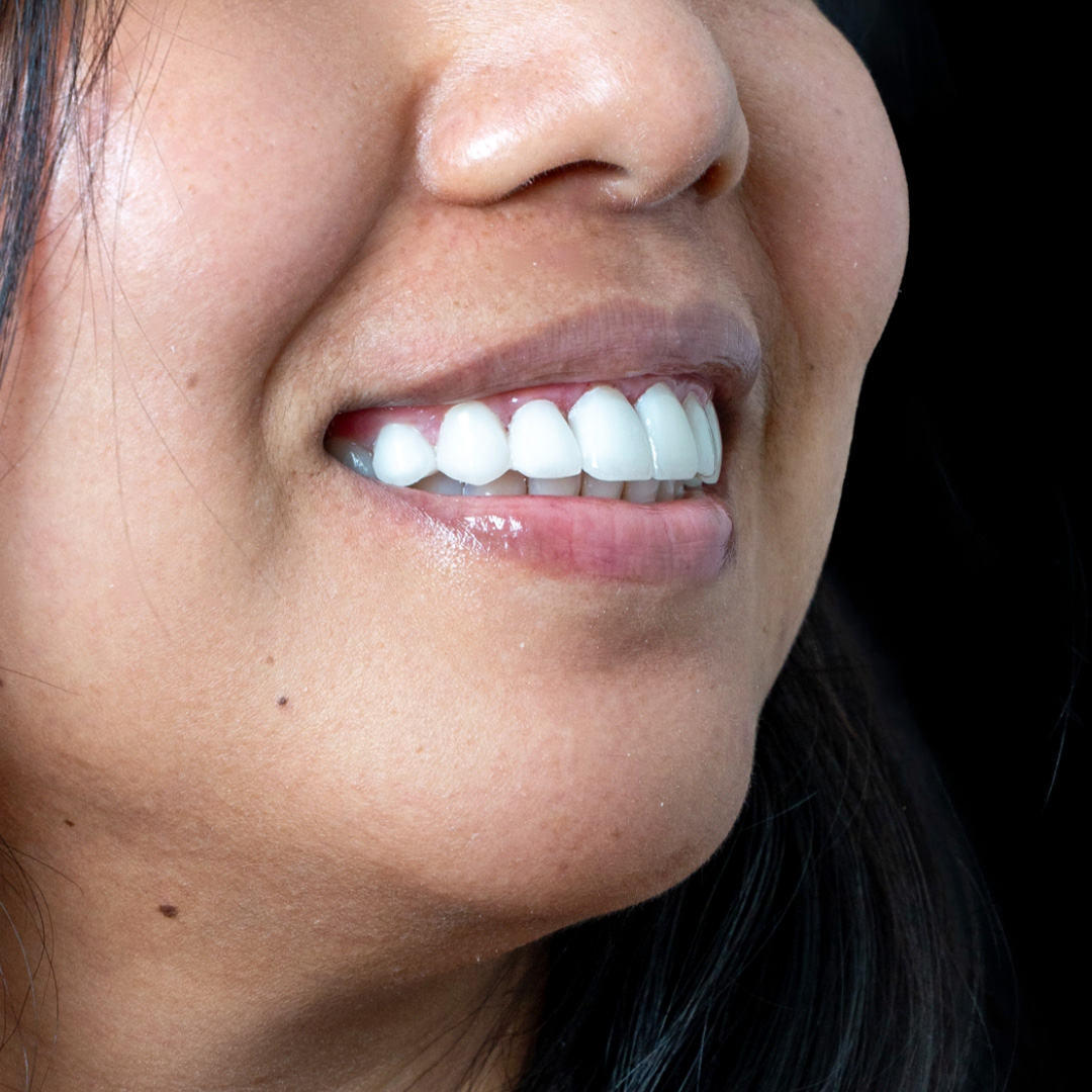 Veneers case 2 after treatment