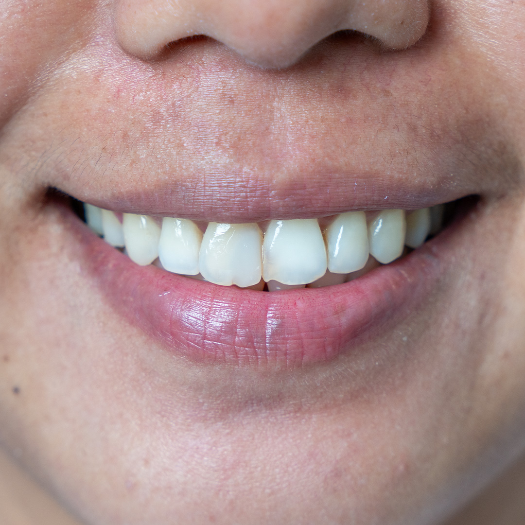 Veneers case 2 before treatment