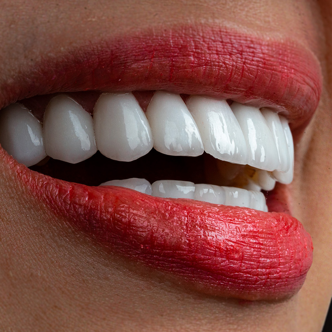 Veneers case 3 after treatment