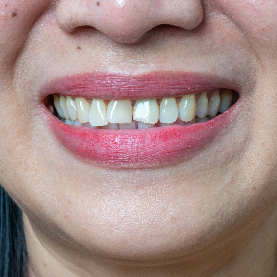 Veneers case 3 before treatment