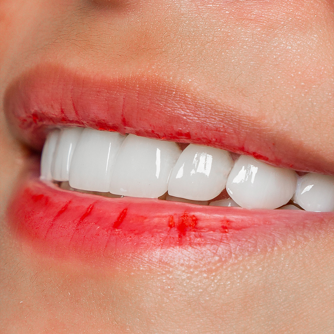 Veneers case 4 after treatment