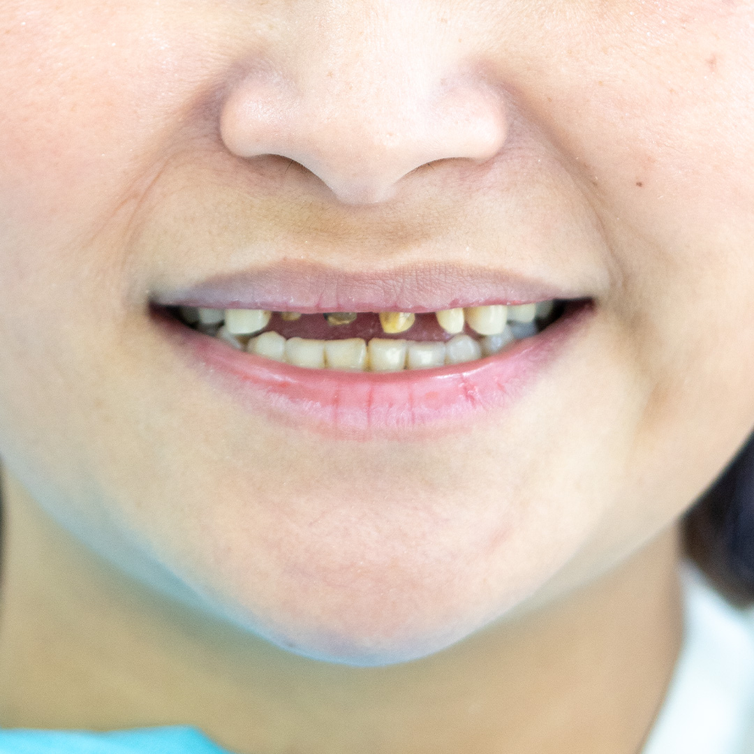 Veneers case 4 before treatment