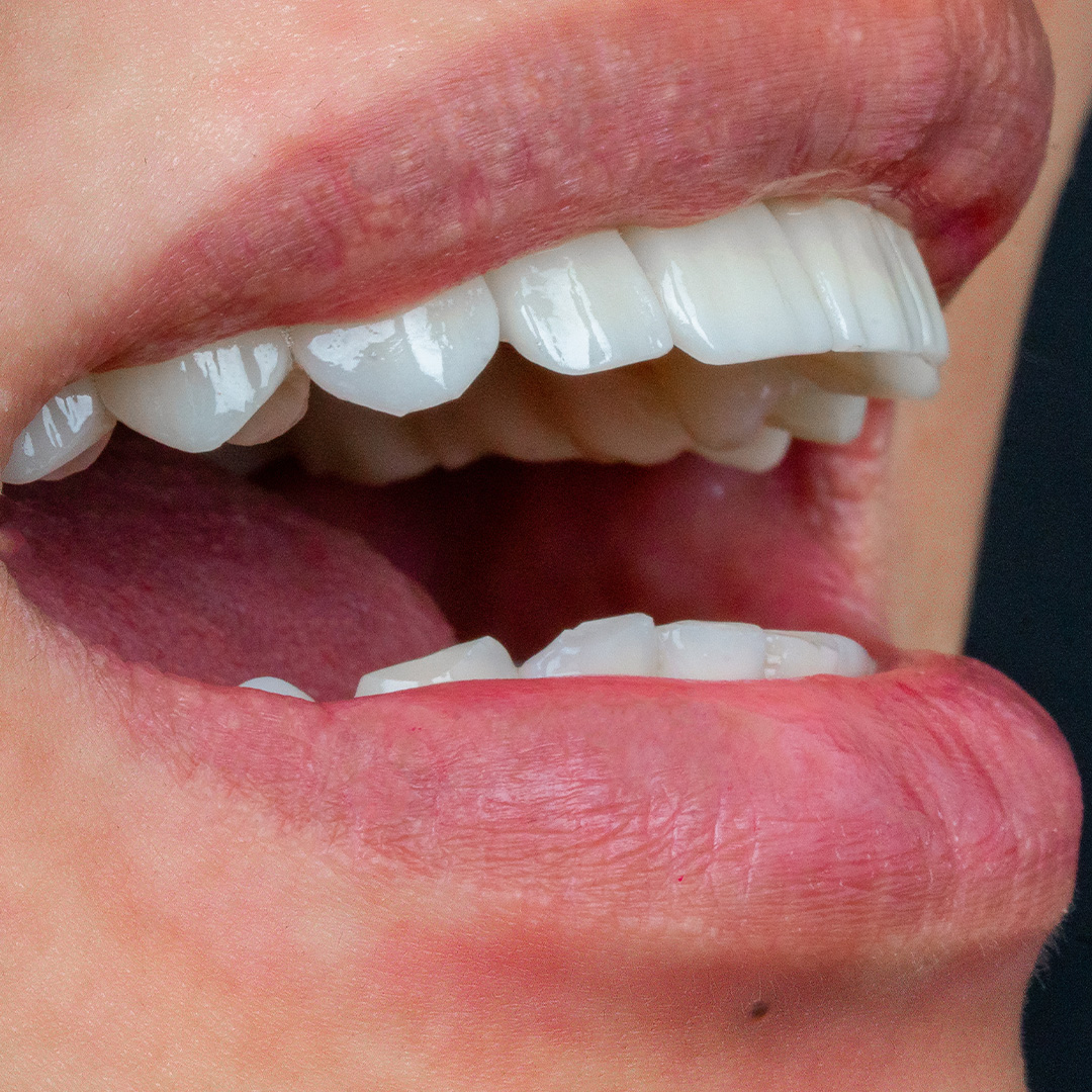 Veneers case 5 after treatment