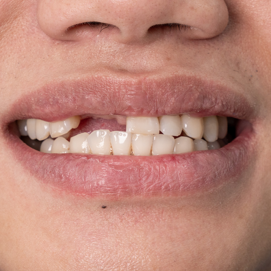 Veneers case 5 before treatment