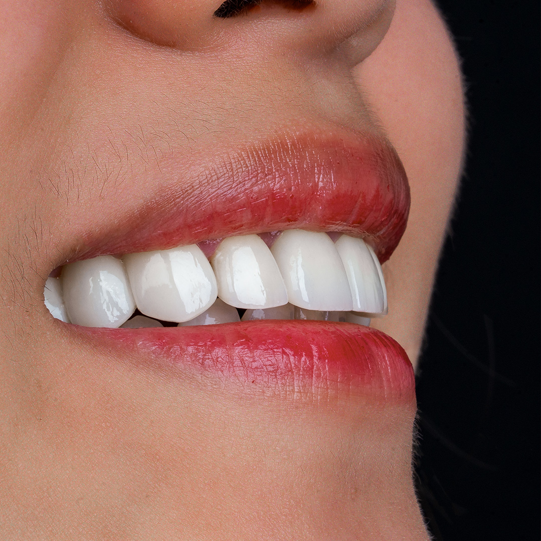 Veneers case 6 after treatment