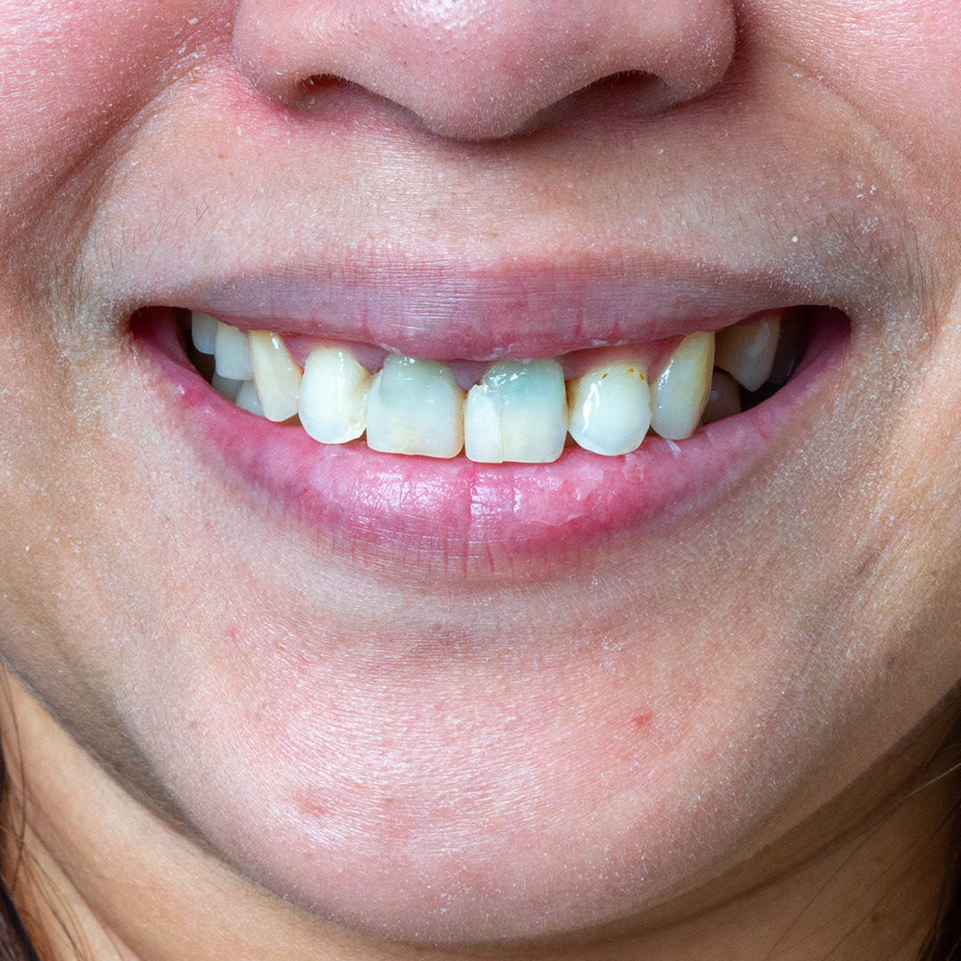 Veneers case 6 before treatment
