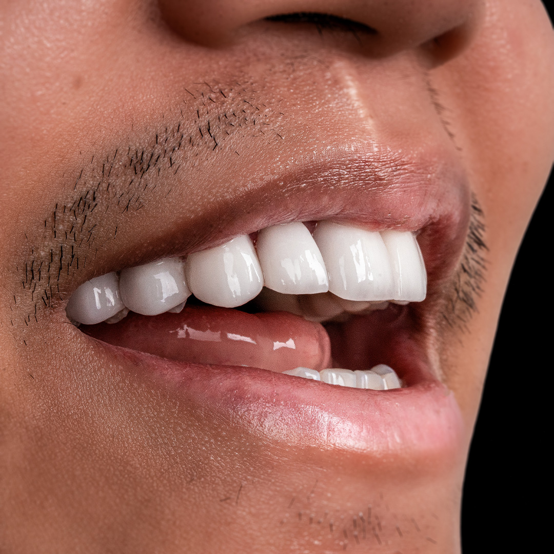 Veneers case 7 after treatment