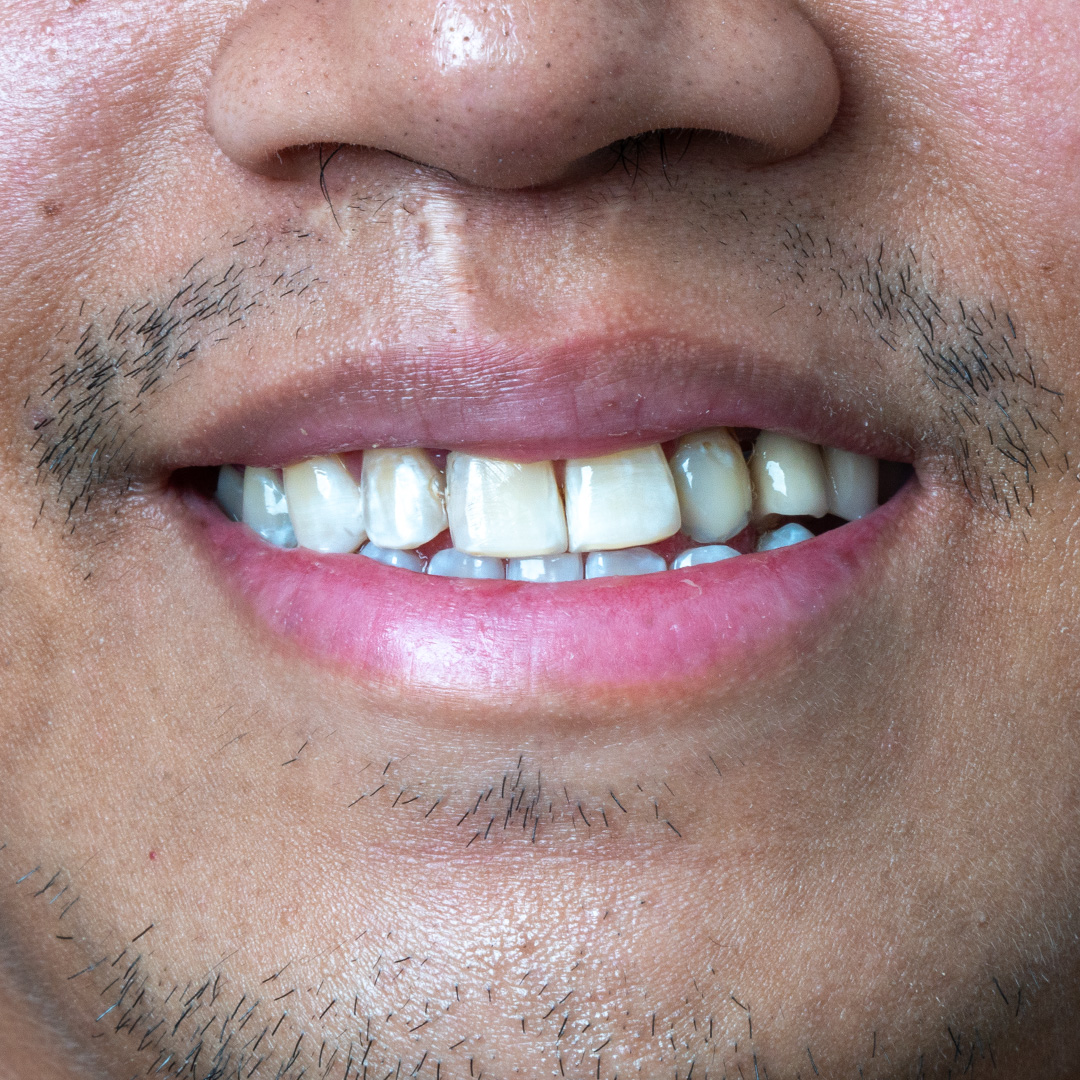 Veneers case 7 before treatment