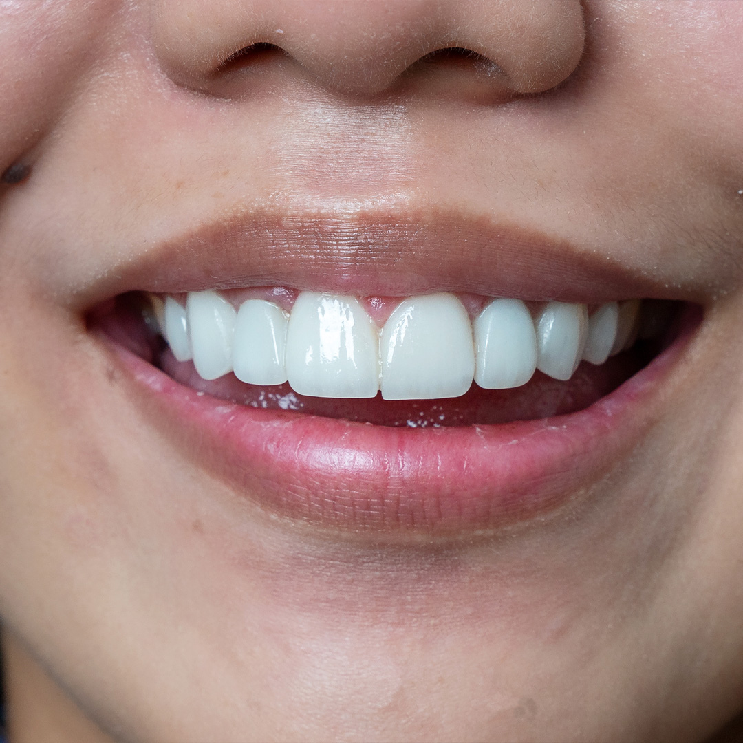 Veneers case 8 after treatment