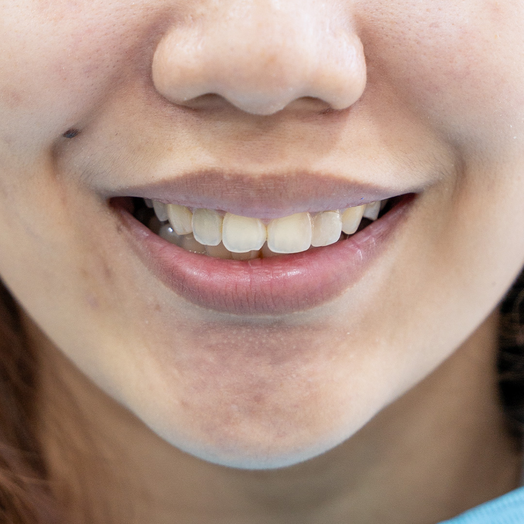 Veneers case 8 before treatment