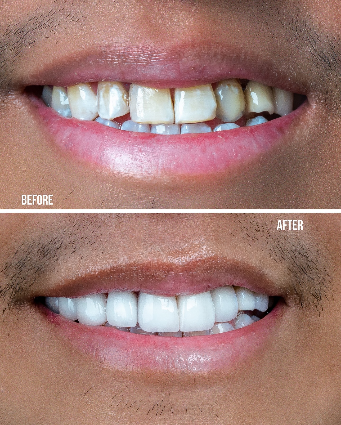 Veneers case 1 before and after