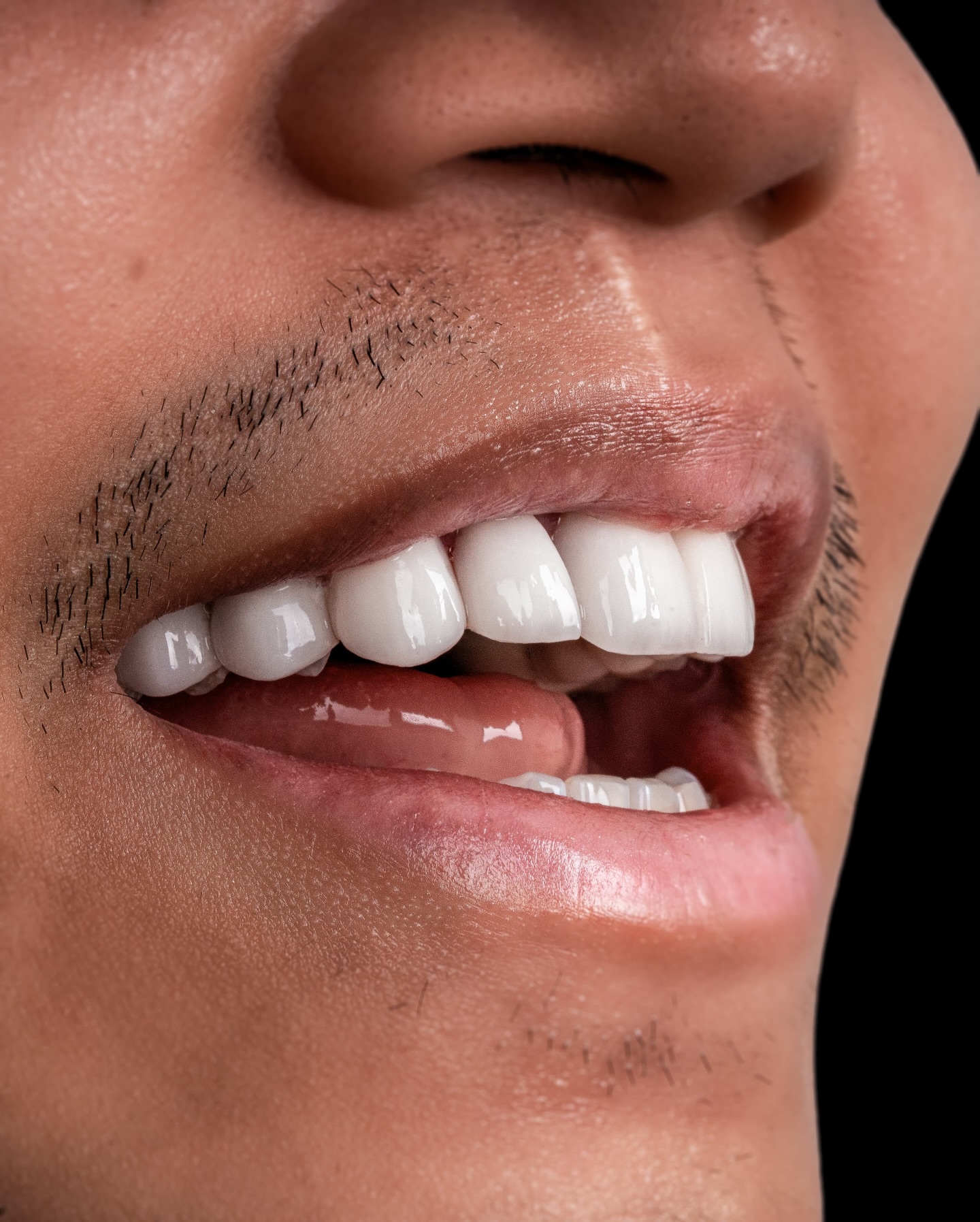 Veneers case 1 result close-up