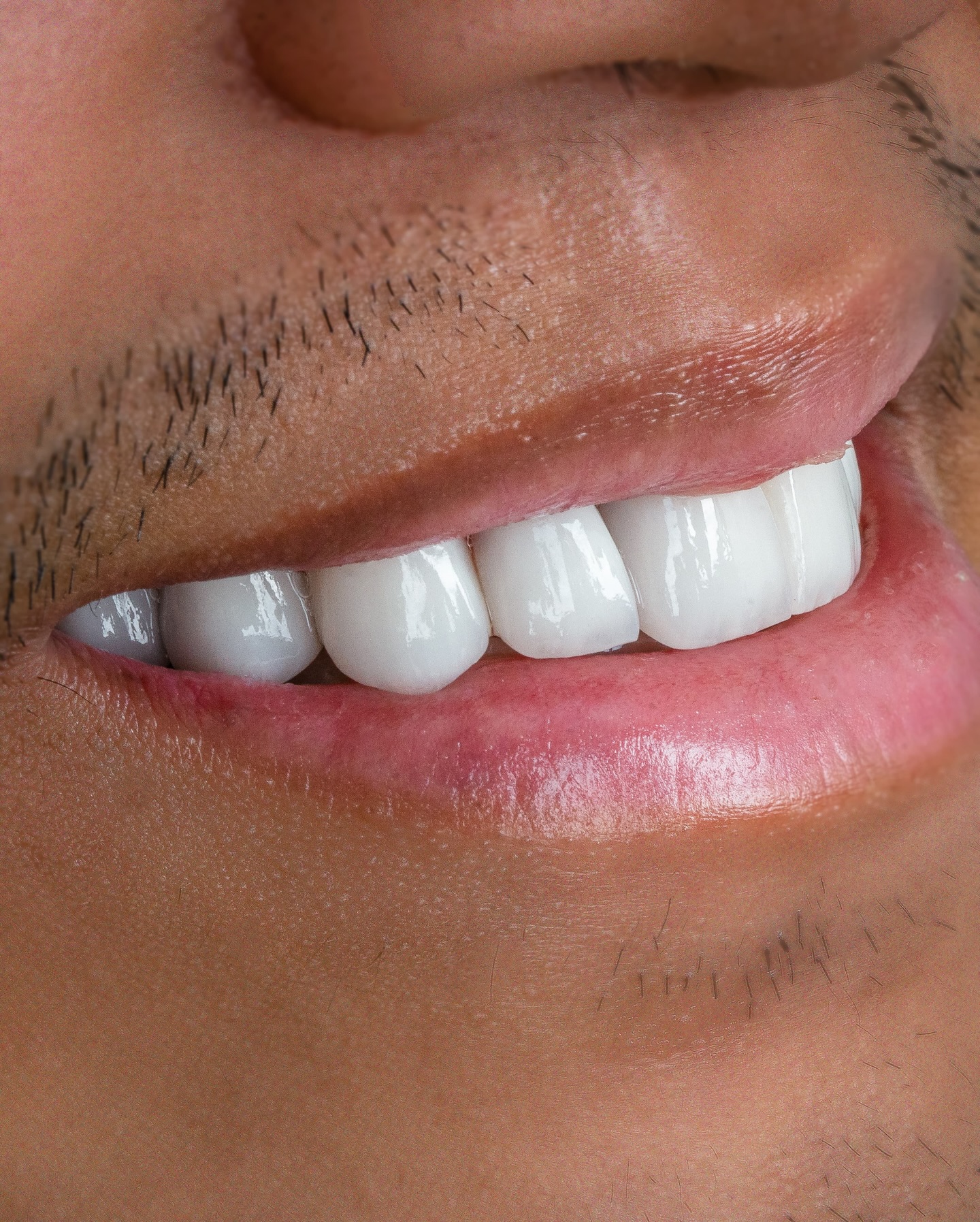 Veneers case 1 result close-up