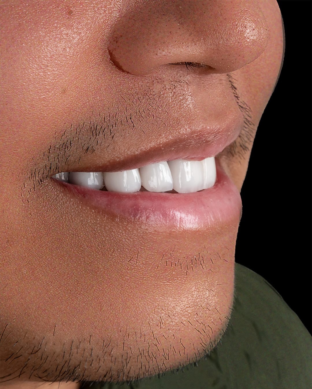 Veneers case 1 result close-up