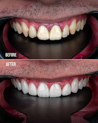 Veneers case 2 before and after