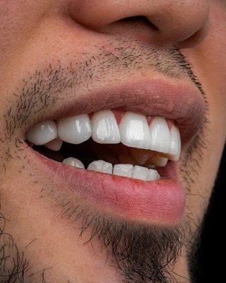 Veneers case 2 result close-up