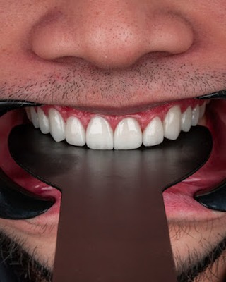 Veneers case 2 procedure