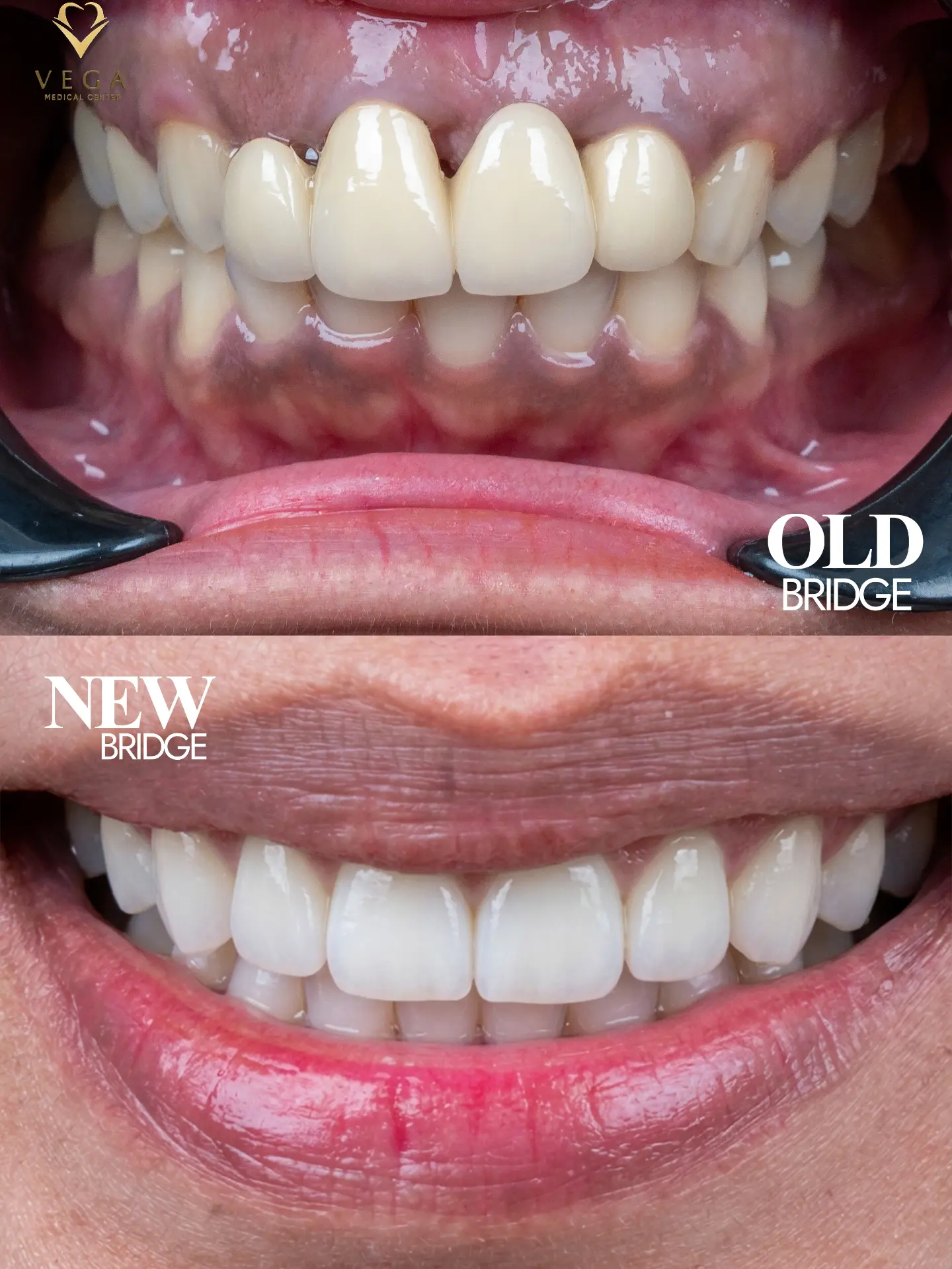 Veneers case 3 old bridge vs new bridge