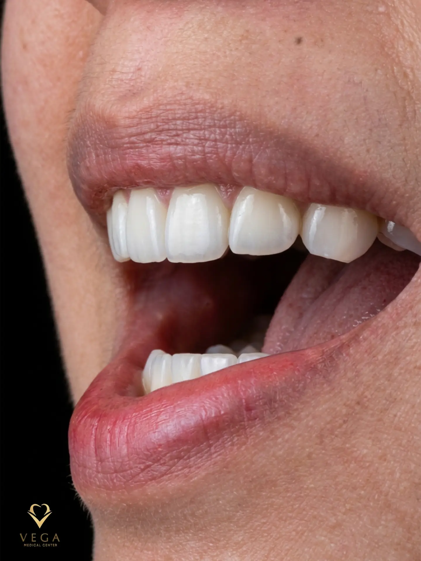 Veneers case 3 result close-up