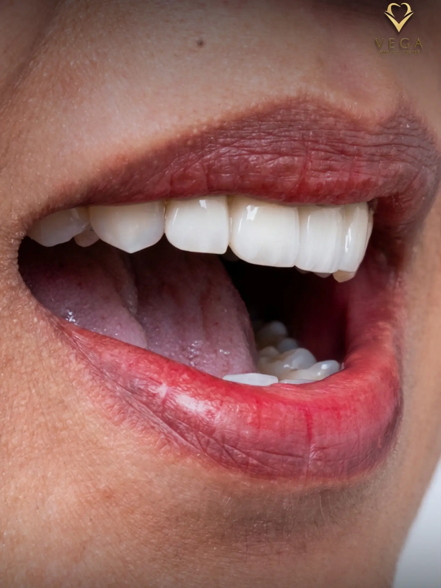 Veneers case 3 result close-up