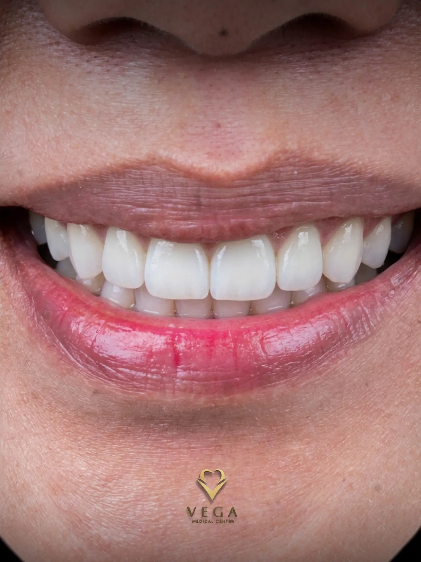 Veneers case 3 result close-up