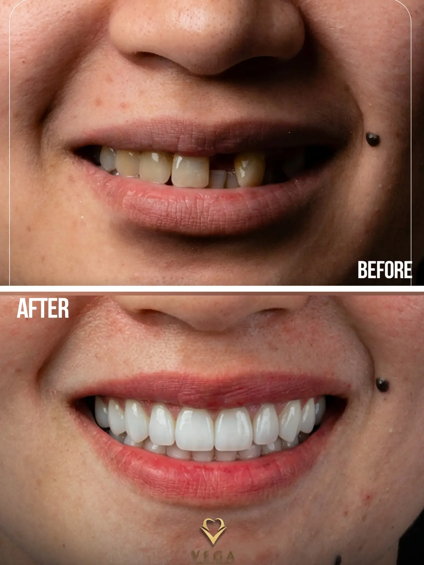 Veneers case 4 before and after