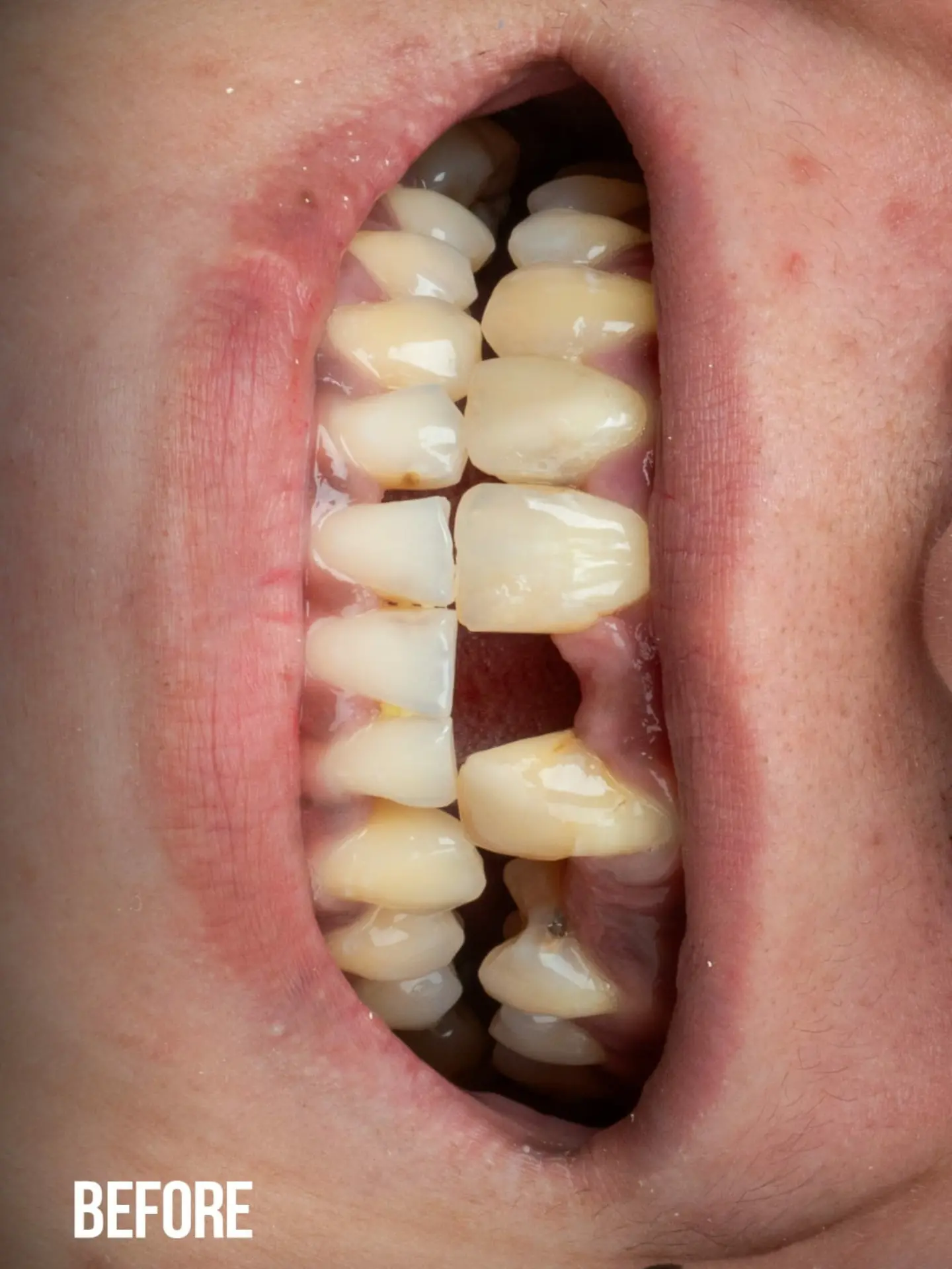 Veneers case 4 before treatment