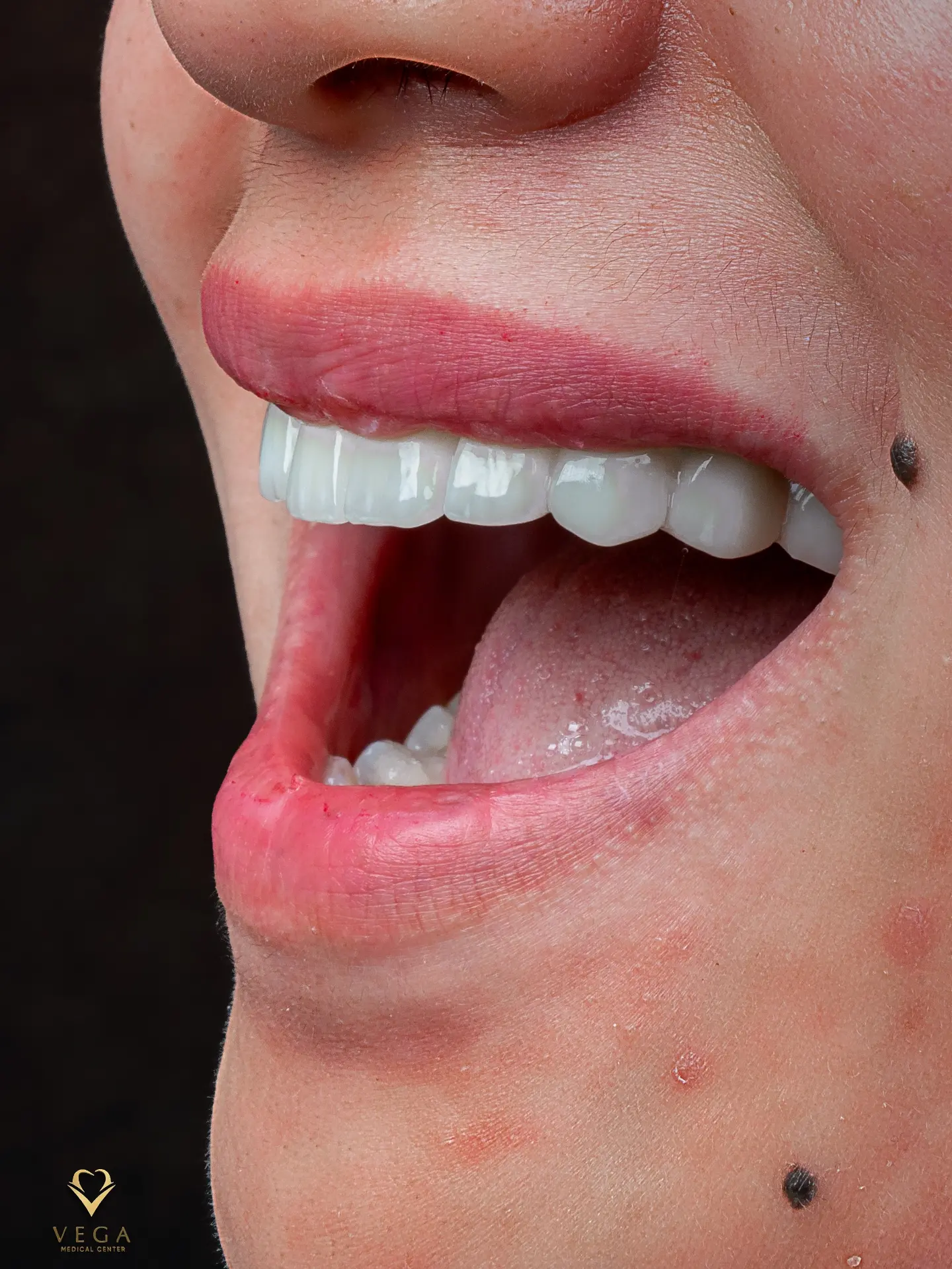 Veneers case 4 result close-up