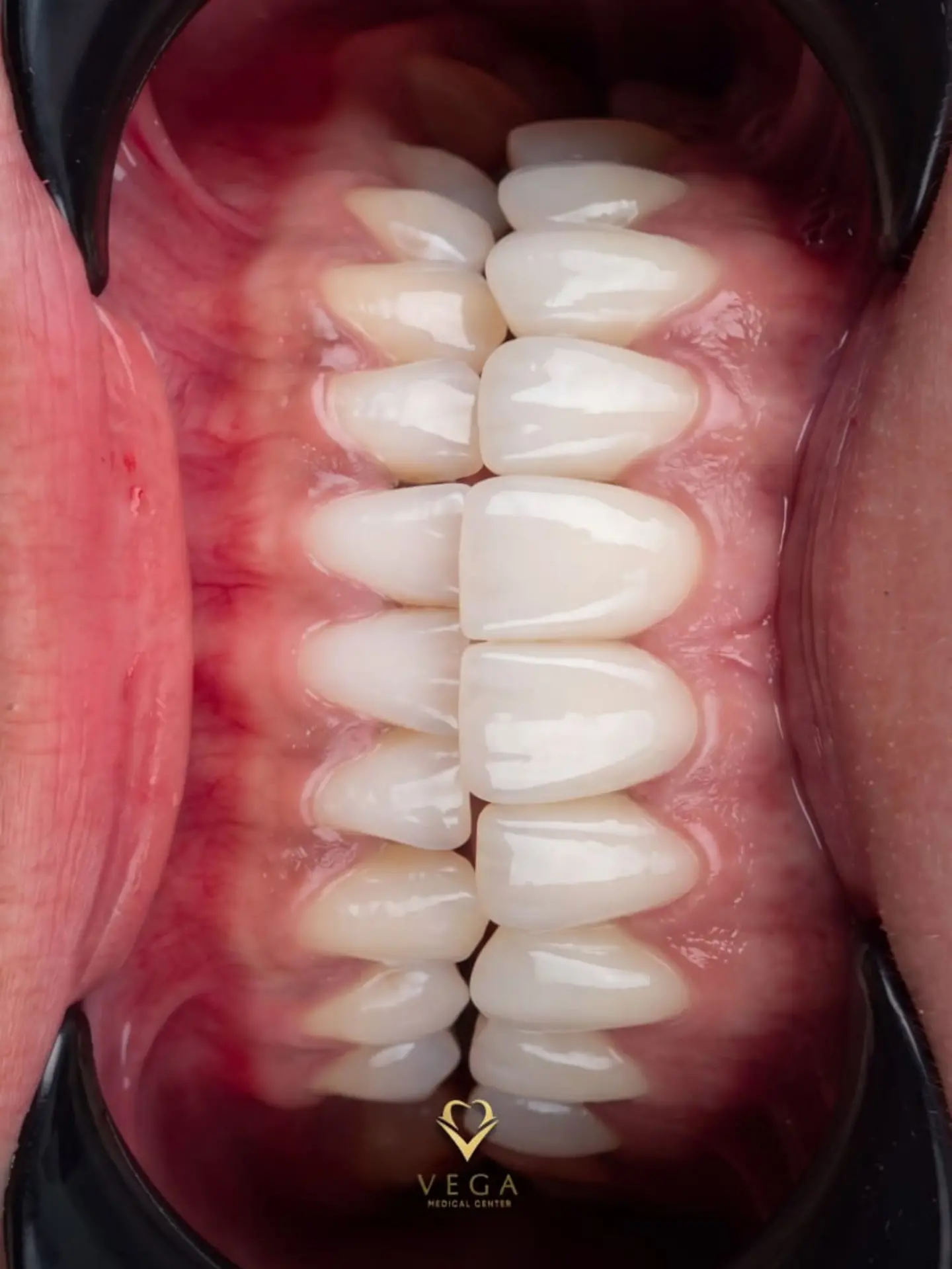 Veneers case 4 result close-up