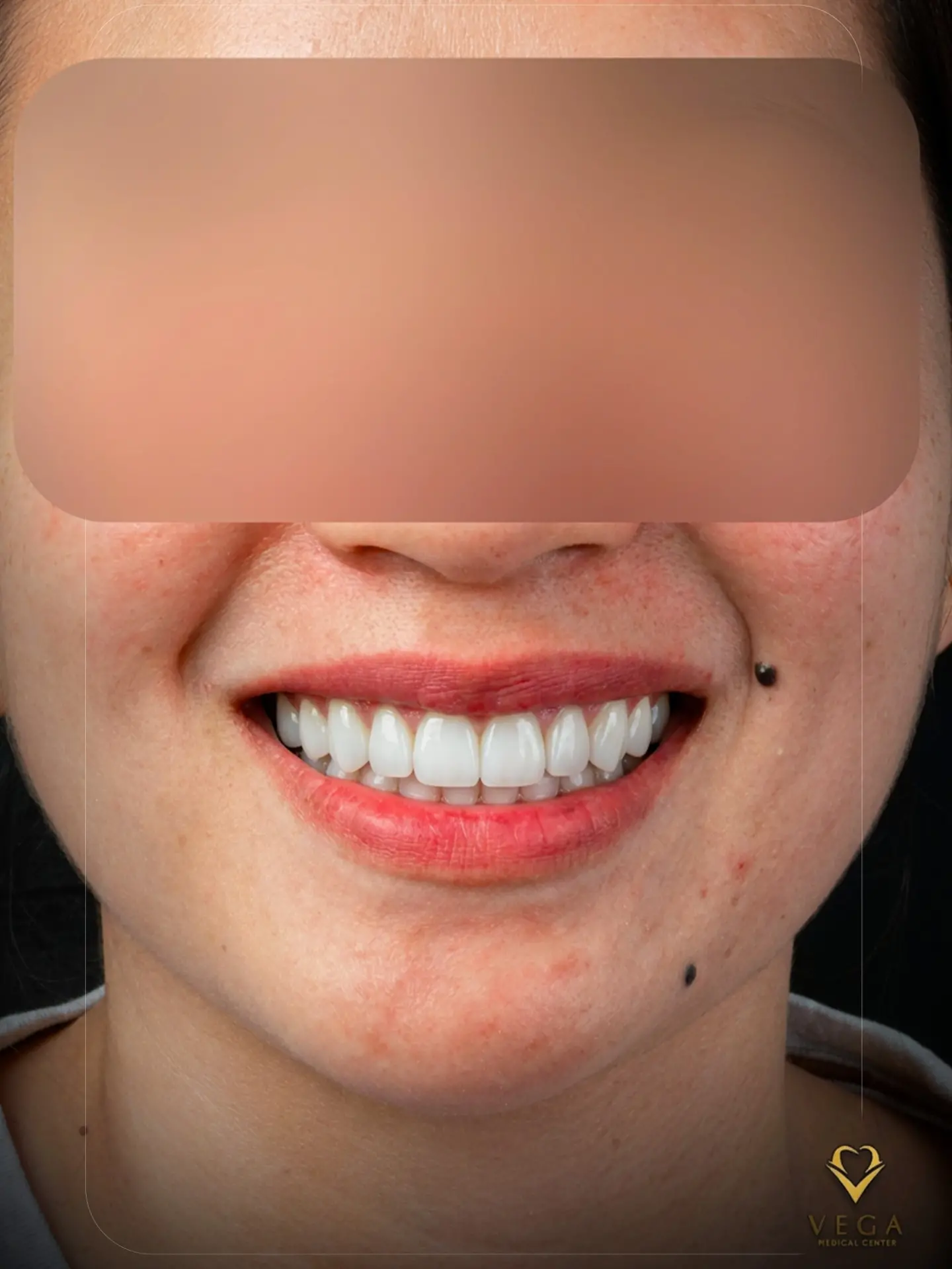 Veneers case 4 result close-up