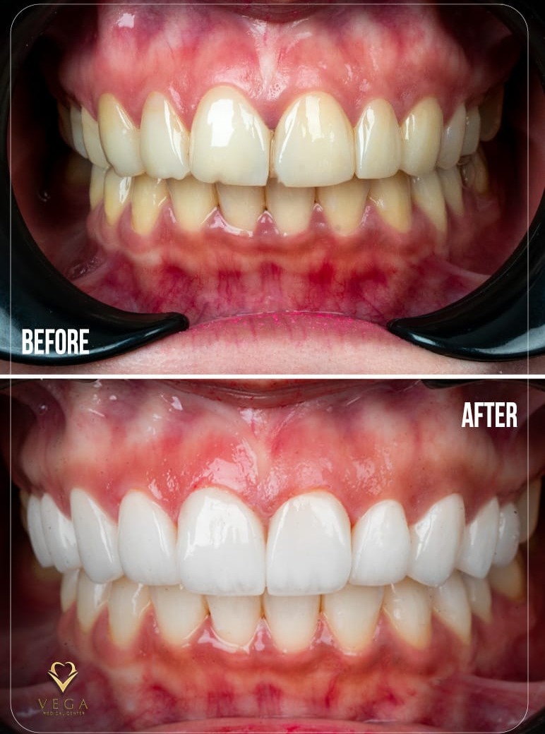 Veneers case 5 before and after