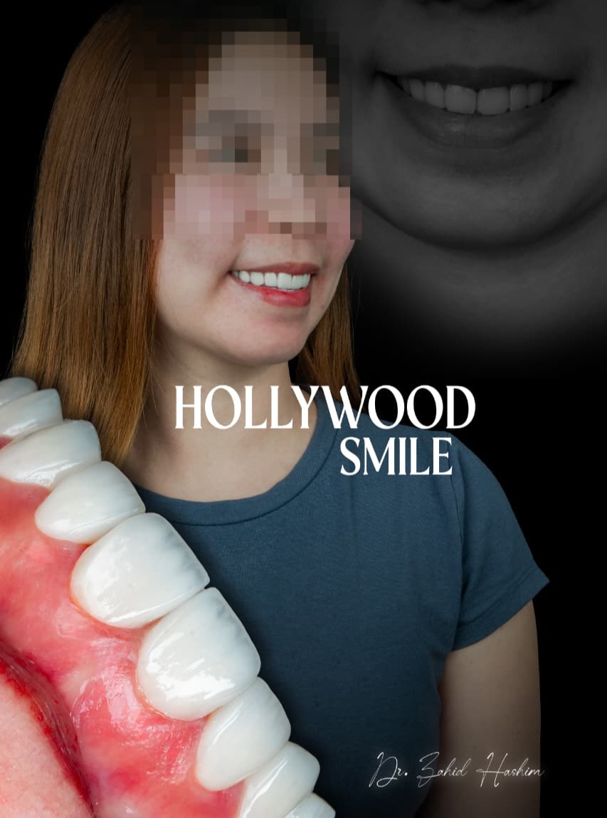 Veneers case 5 result close-up