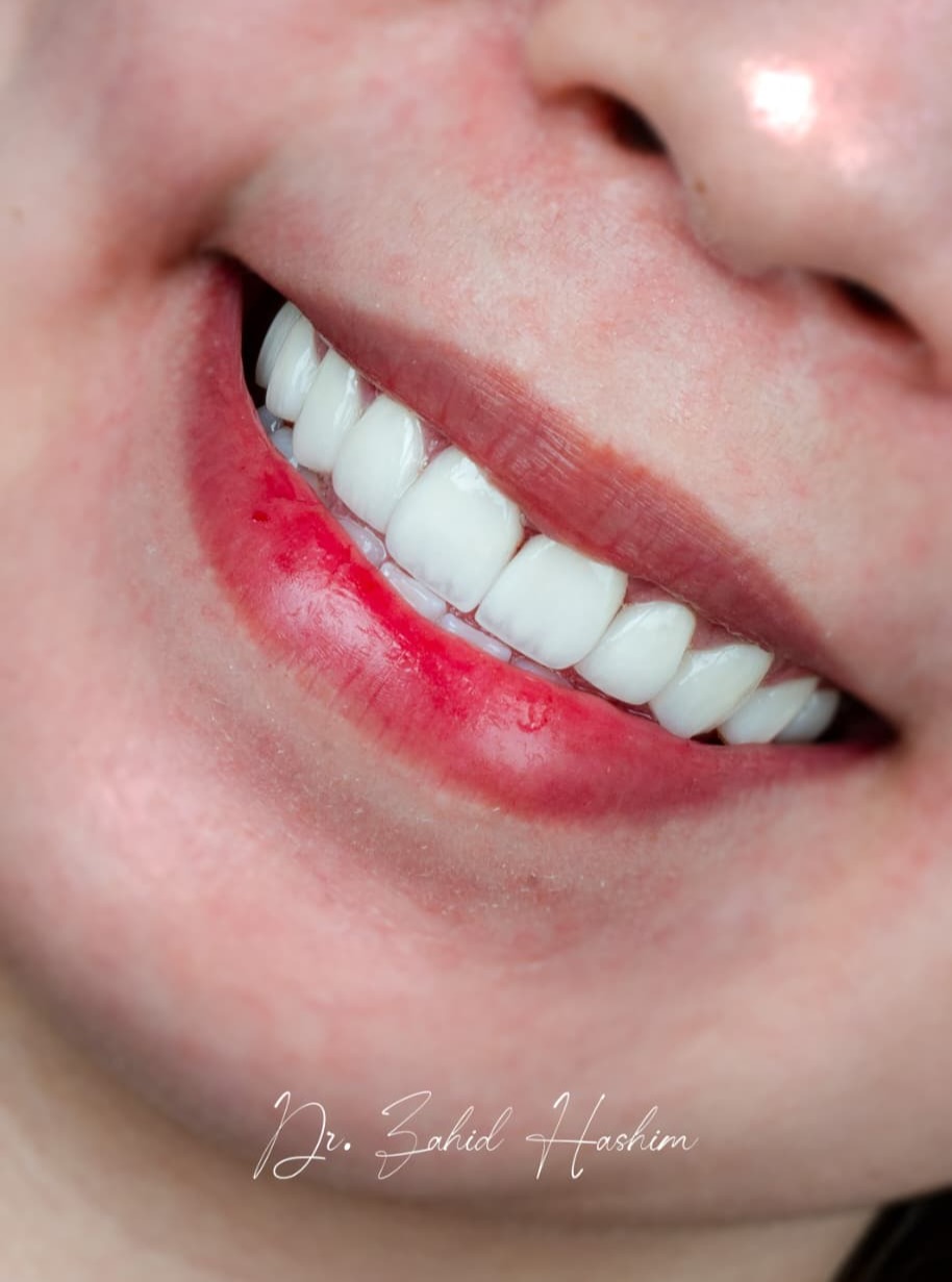 Veneers case 5 result close-up