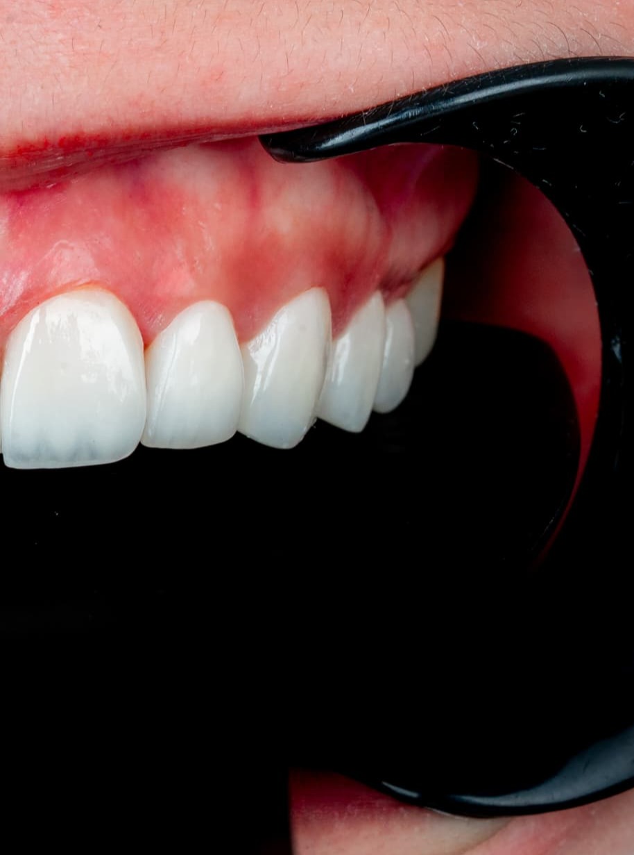 Veneers case 5 result close-up