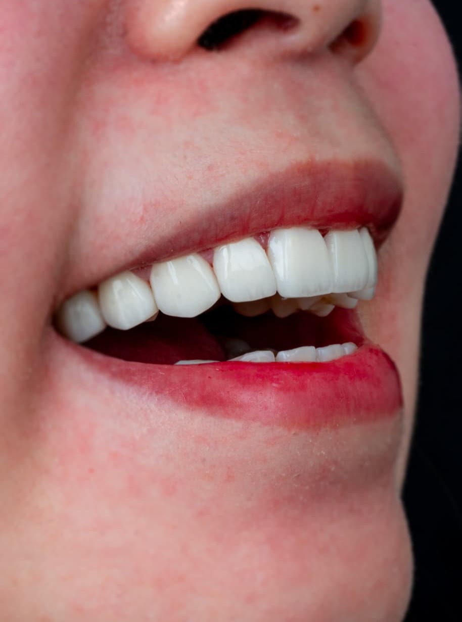 Veneers case 5 result close-up