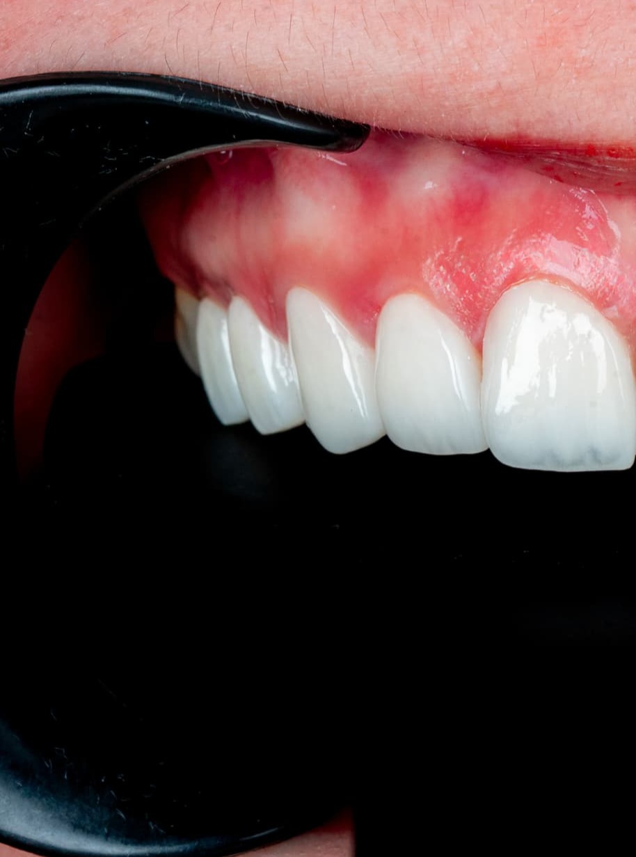 Veneers case 5 result close-up