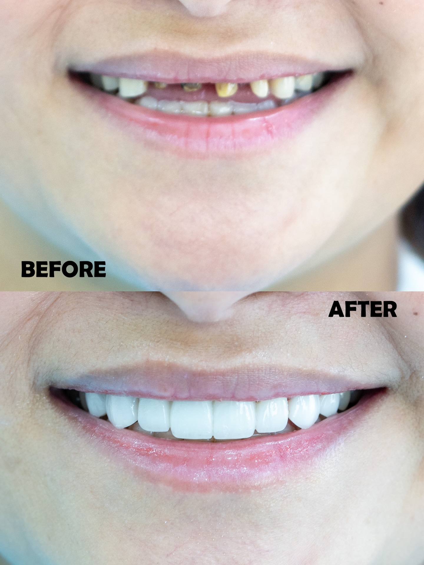 Veneers case 6 before and after