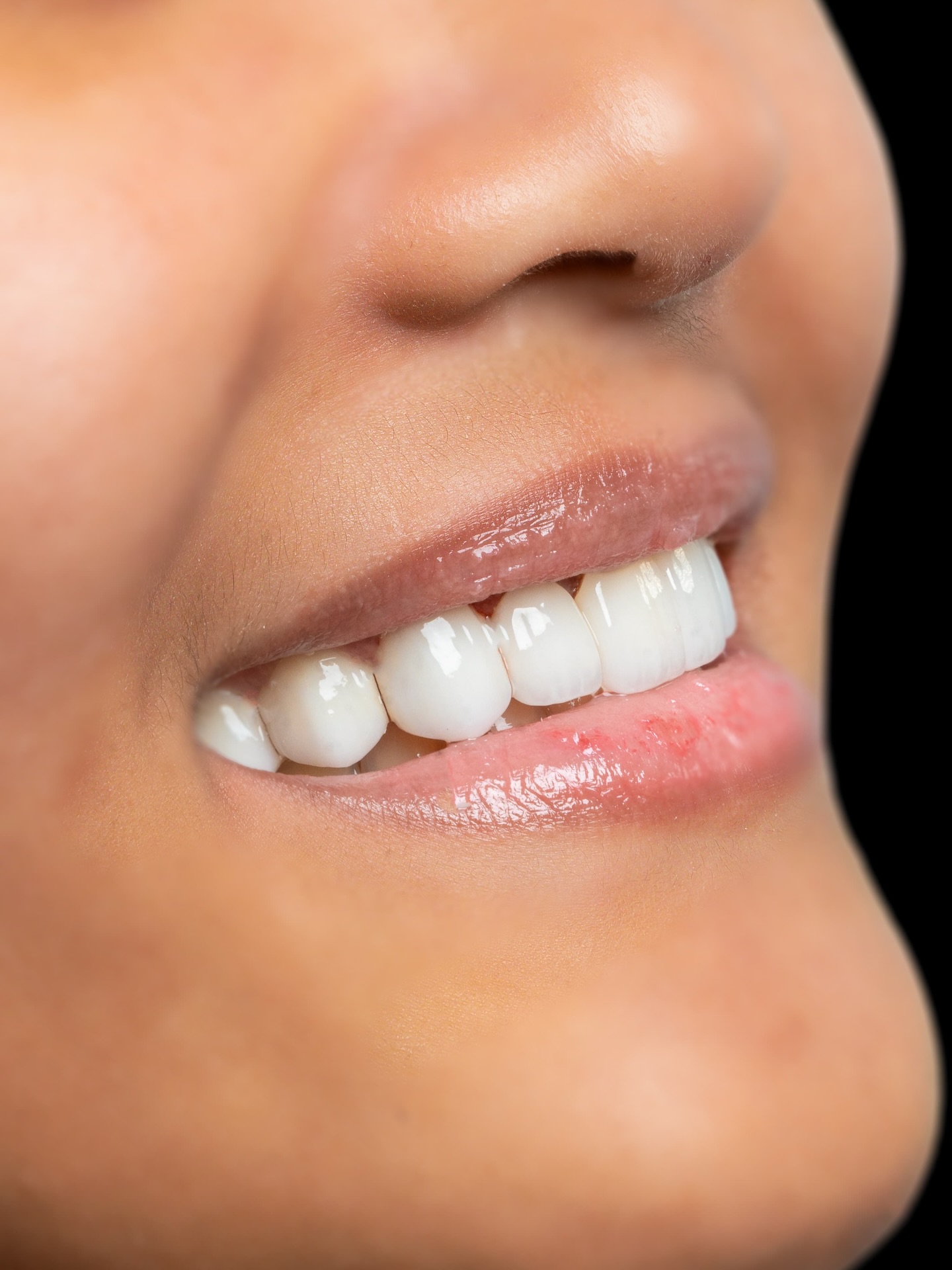Veneers case 7 result close-up