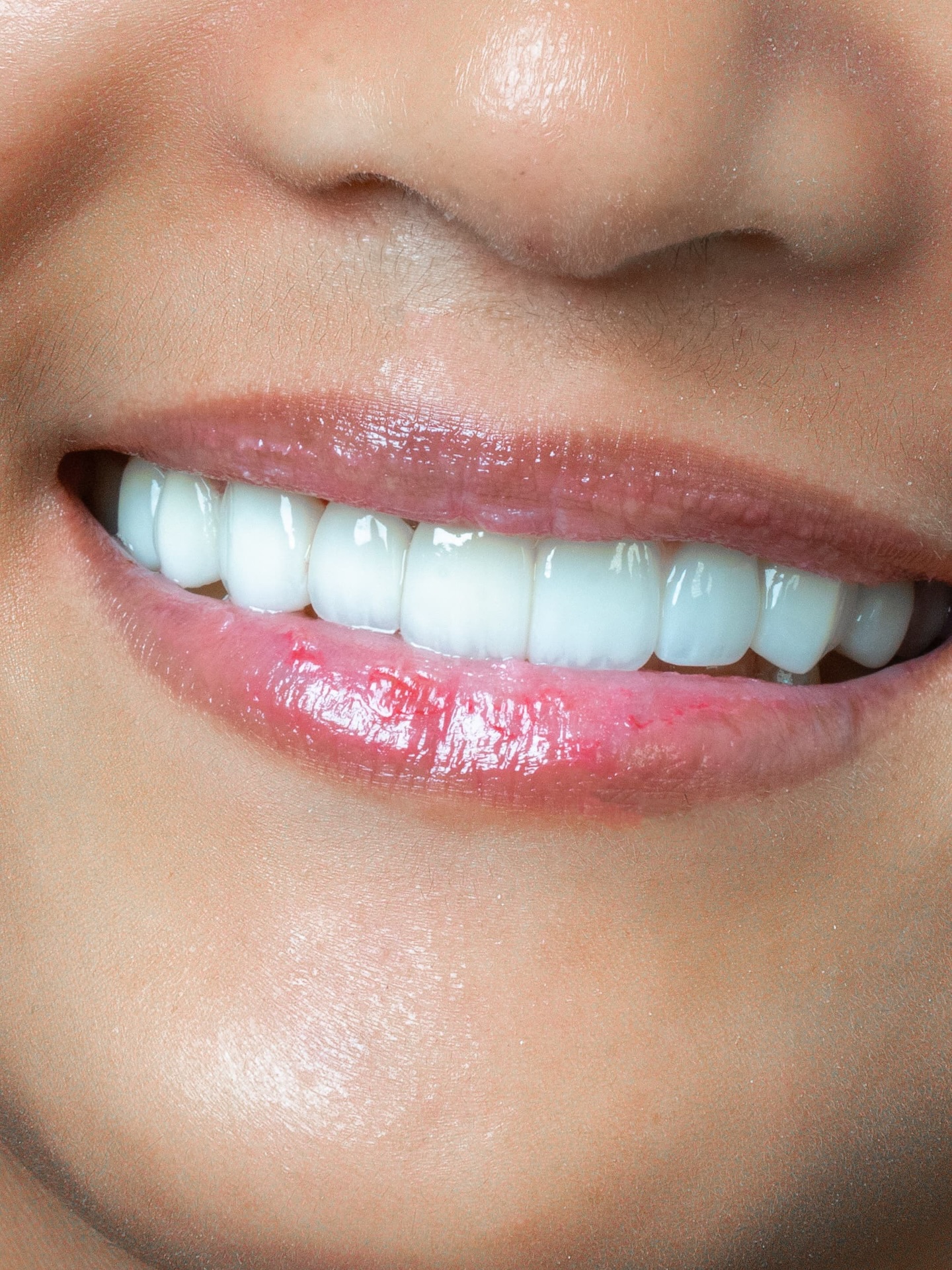 Veneers case 7 result close-up