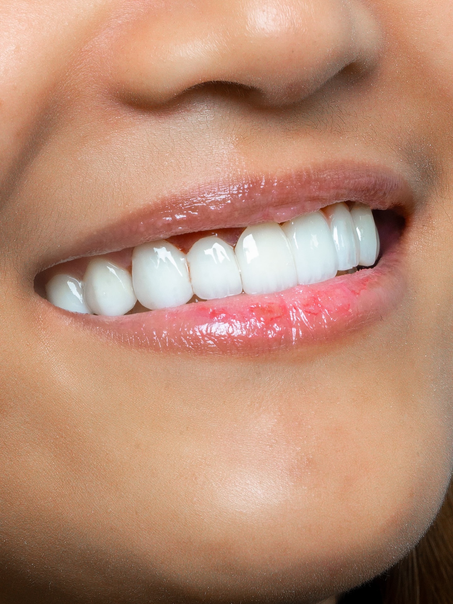 Veneers case 7 result close-up