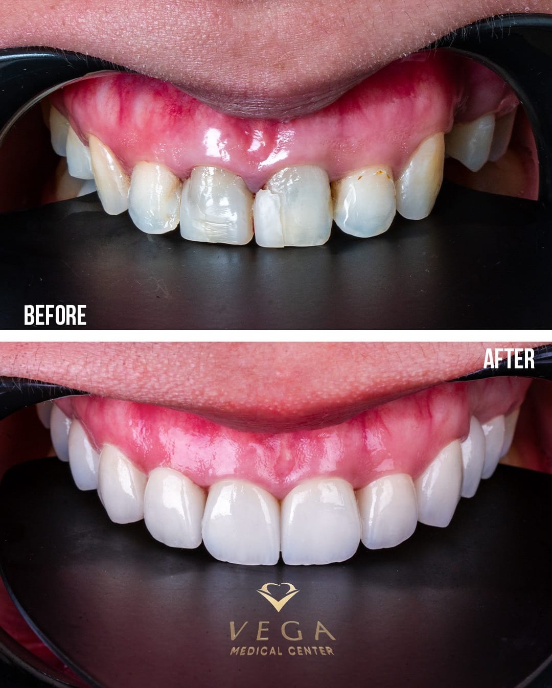 Veneers case 8 before and after
