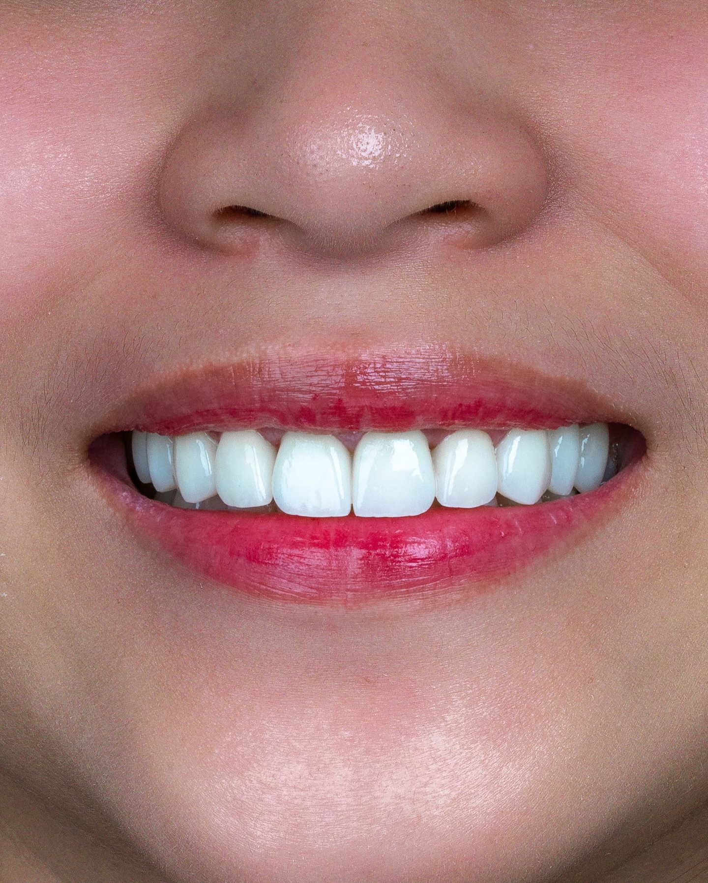 Veneers case 8 result close-up