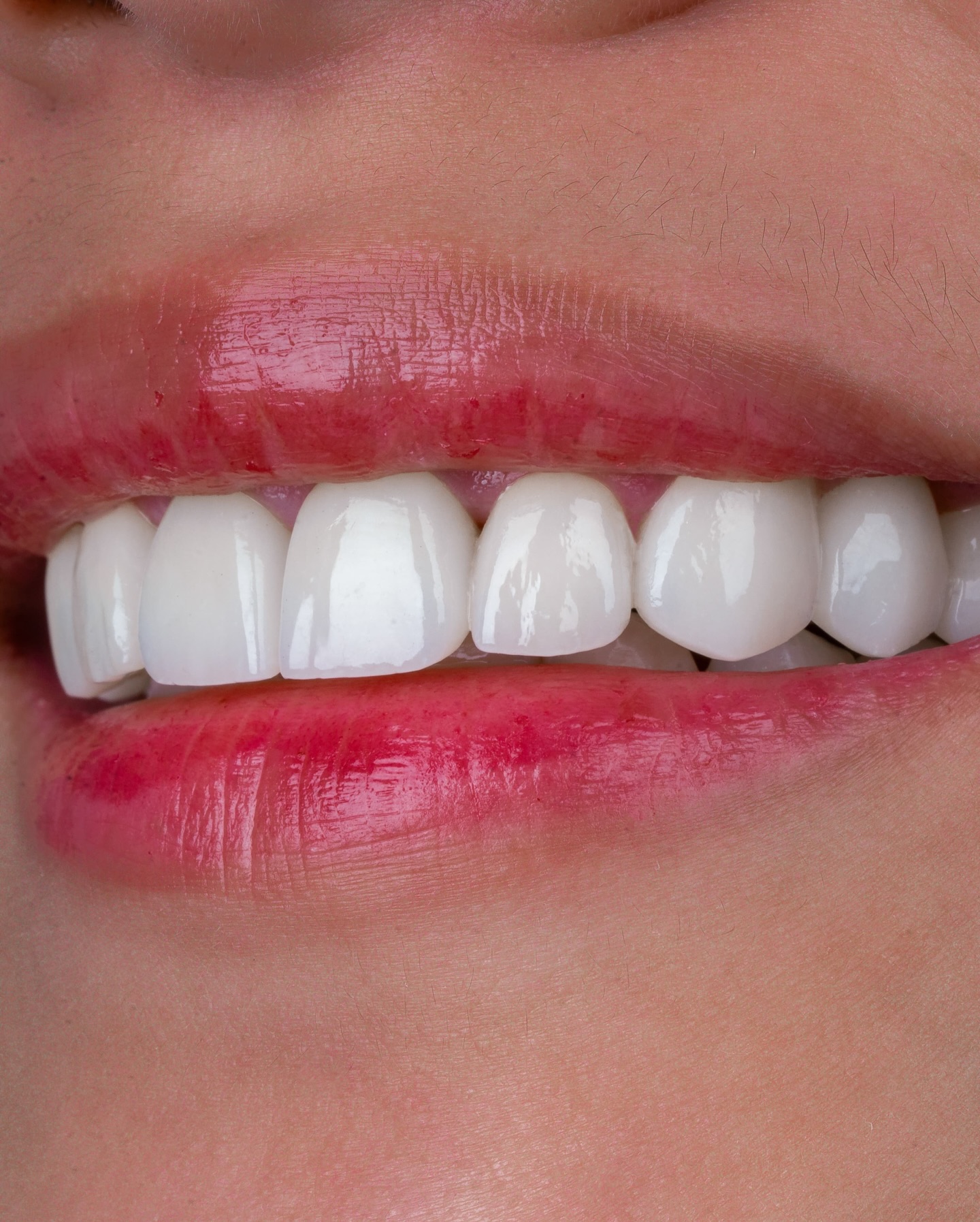 Veneers case 8 result close-up