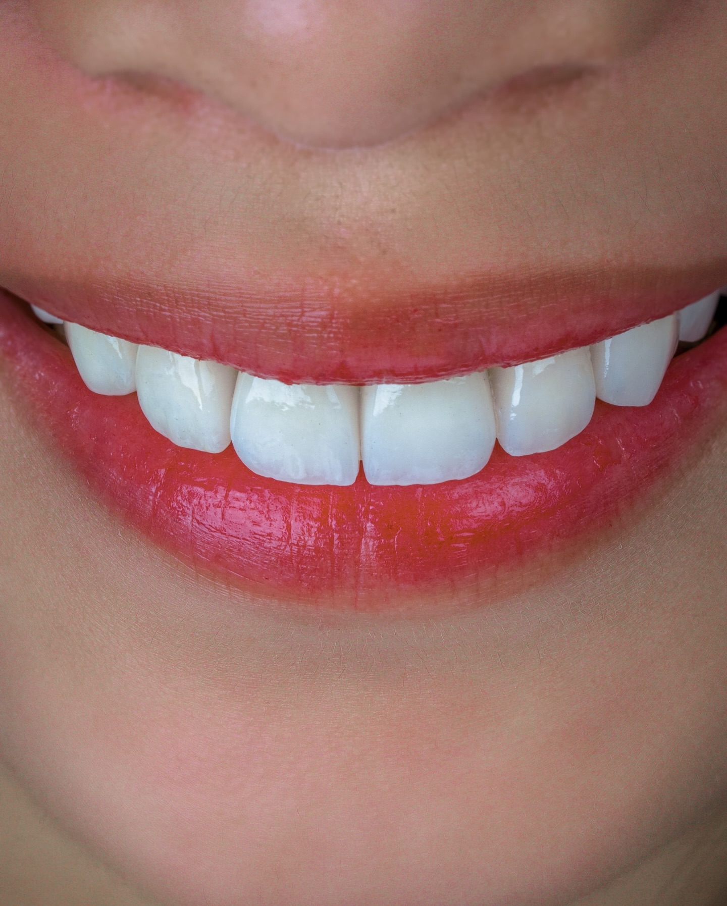 Veneers case 8 result close-up