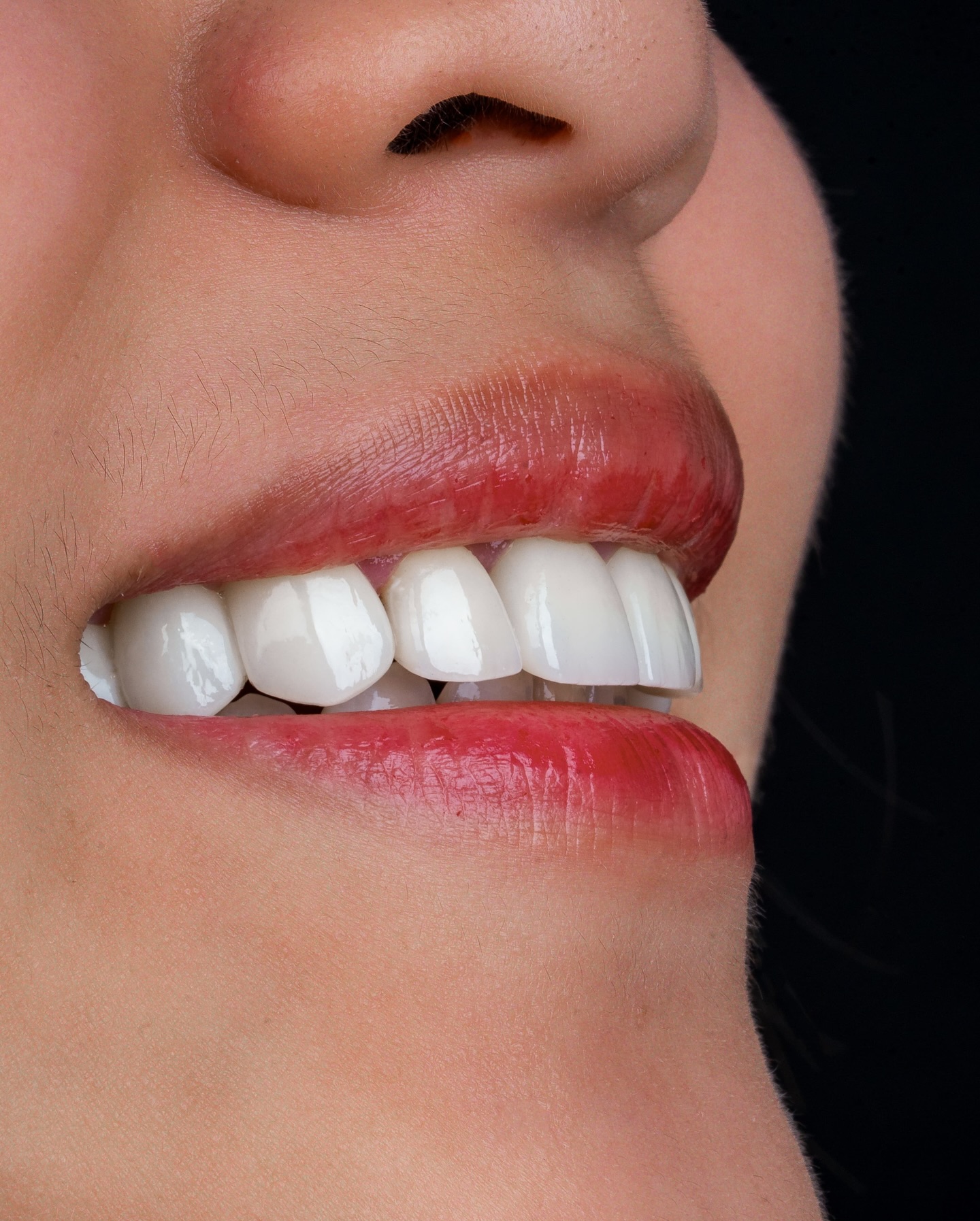 Veneers case 8 result close-up