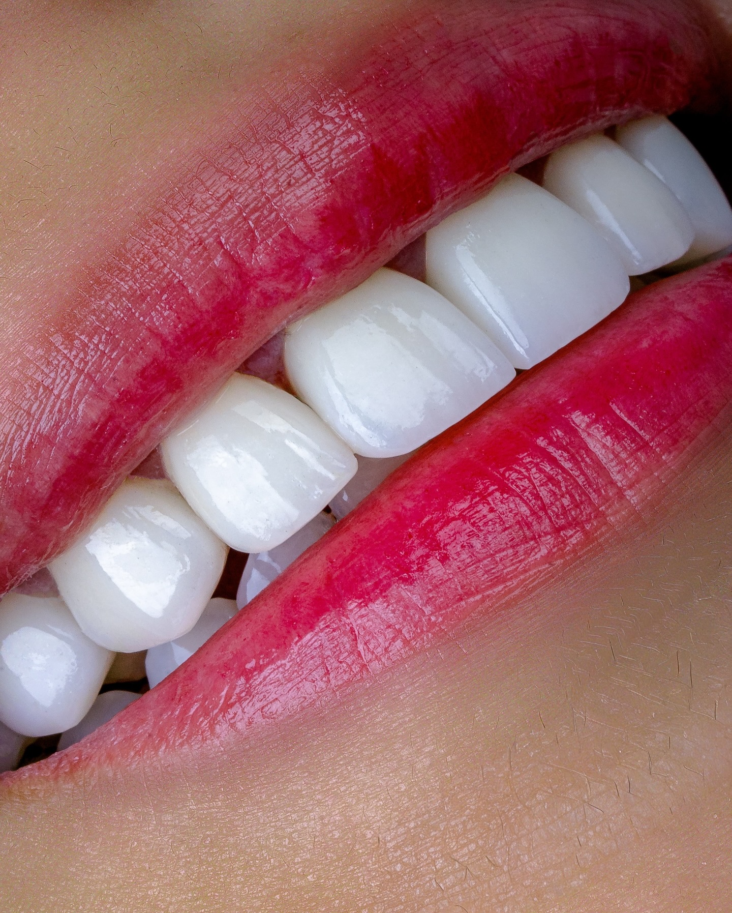 Veneers case 8 result close-up