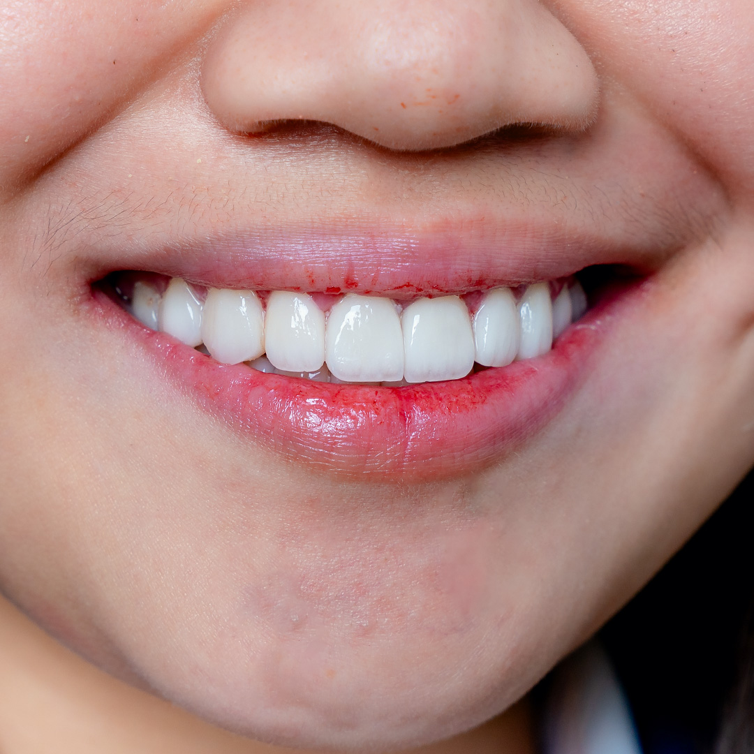 Close-up of natural-looking dental veneers by Vega Medical Center