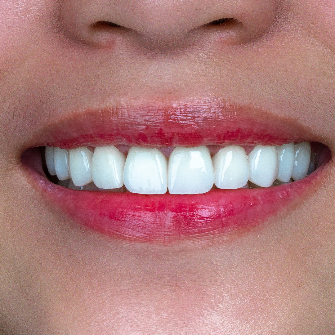 Close-up of natural-looking dental veneers by Vega Medical Center